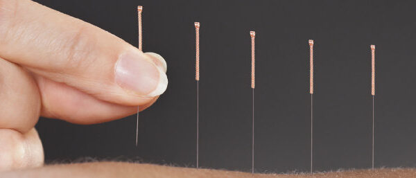 Acupunctuur / Pijnloze laser acupunctuur